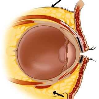 Why Dissolving Eye Bag Fat is Dangerous #eyebags #eyebagsurgery #eyebagremoval #EyeBagCream #blephar