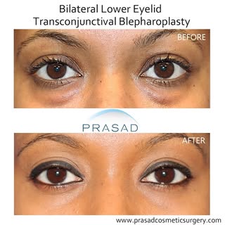 When Eye Bags Need Surgery, Not Filler #eyebags #blepharoplasty #lowerblepharoplasty #eyebagsurgery 