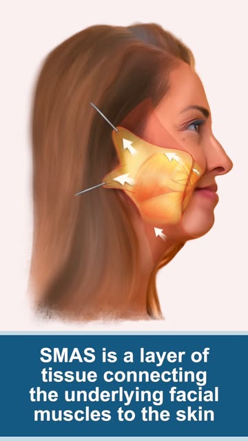 Lasting Facelifts: Why the Muscle is the Secret #facelift #facelifting #FaceliftSurgery #smasfacelif