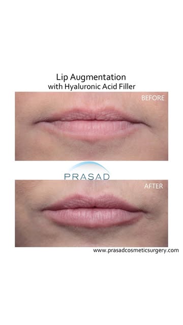 Top 2 Lip Filler Fears (And How to Avoid Them) #lipfiller #LipAugmentation #lipenhancement ##hyaluro