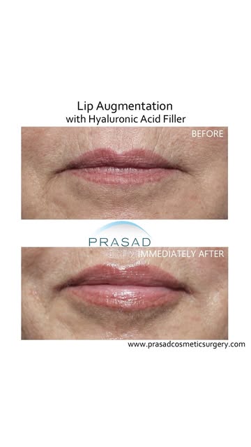 The Secret to Lip Filler Without the Bruising #lipfiller #LipEnhancement #Restylanekysse #restylanel