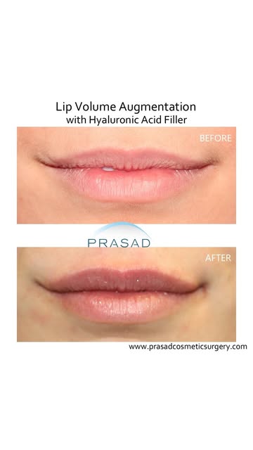 Lip Filler that Looks Natural and Expressive #lipfiller #lipfillerbeforeandafter #lipenhancement #re