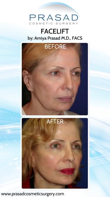 Different Facelifts for Different Ages #facelift #facelifting #deeplanefacelift #smasfacelift #minif