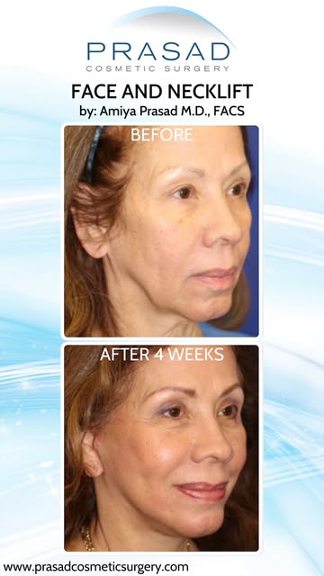 Why Some Facelift Techniques Disappear #facelift #facelifting #cosmeticsurgery #CosmeticSurgeon #Fac