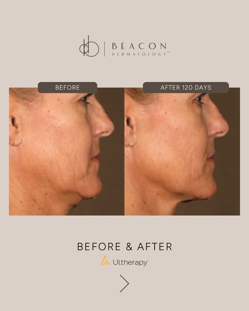 The best part? Your results don't stop when the treatment ends. Ultherapy works by stimulating your 