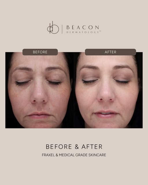 Did summer leave its mark? ☀️

Months of sun exposure can leave behind more than a tan. Pigmentation