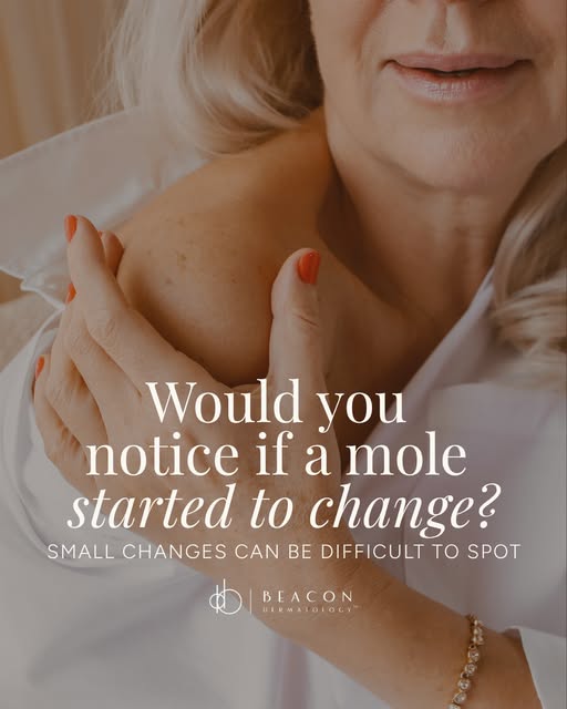 SAVE $100 ON MOLE MAPPING 🔎 Know your skin. Track what changes. Take a proactive approach to your s
