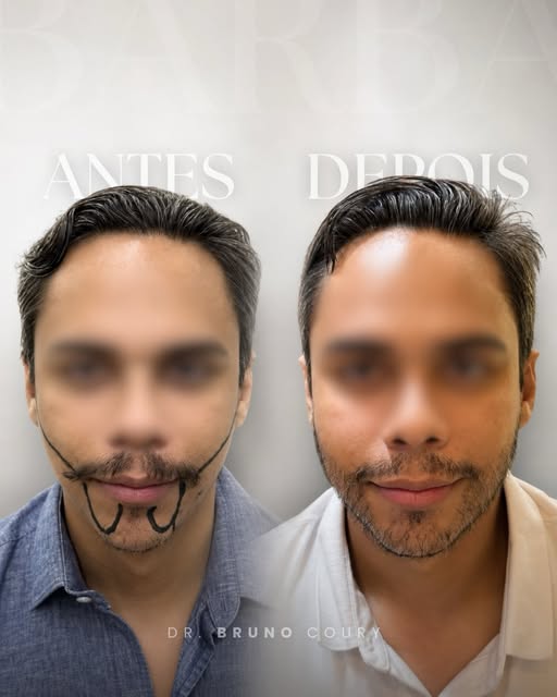 Nesse resultado parcial, é possível perceber que, antes, praticamente não havia barba nas laterais. 