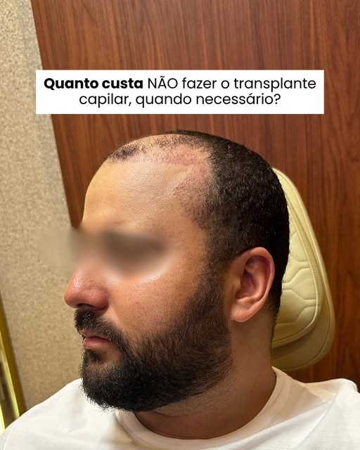 A calvície não incomoda todo mundo da mesma forma. Mas, quando começa a interferir nas fotos, no cor