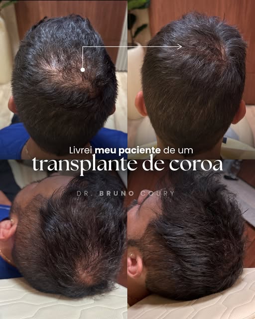 Este paciente chegou acreditando que precisaria passar por um segundo transplante na região da coroa