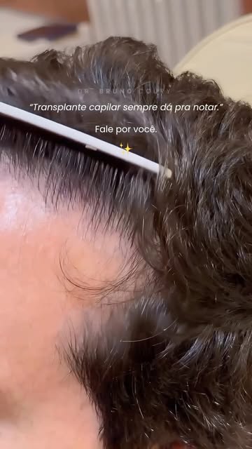 Por aqui, trabalhamos com transplantes capilares impecáveis. 🤭✨