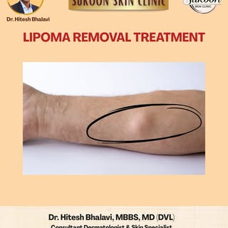 Sukoon Clinic में अब लिपोमा रिमूवल का सुरक्षित और प्रभावी उपचार उपलब्ध है।
Dr. Hitesh Bhalavi के साथ