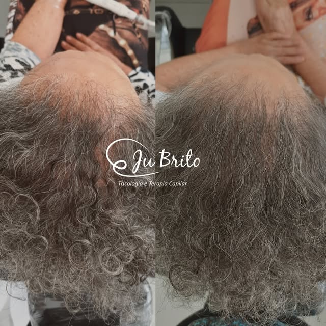 Cuidar do couro cabeludo também é um processo de longo prazo. 💙

Aos 81 anos, essa paciente chegou 