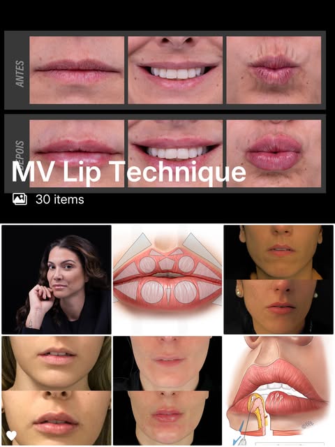 👄// A MV Lip Technique®️ utiliza vetores e formas geométricas para garantir naturalidade, contorno 