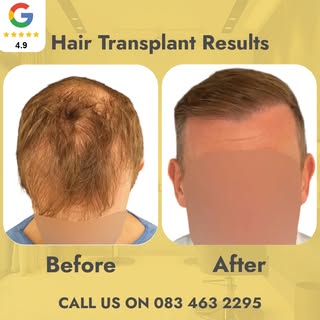 At Millennium Hair Loss Clinic, we specialize in the AHI FUE – the best modern hair transplant metho