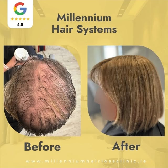 🧠💇‍♂️ 💇‍♀️✨Say goodbye to thinning hair and hello to a fuller, natural-looking you with Millenniu