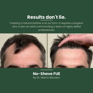 ✂️ No shave. Less downtime. No need to “explain” a shaved head. Faster return to work. 
This is the 