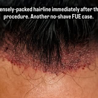 #hairtransplantsurgery #hairrestoration #fue #ishrs #aacs