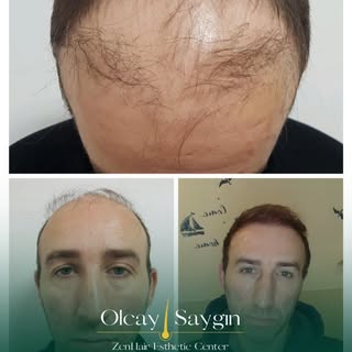 Zen Hair –  Excellence in Modern Hair Restoration

At Zen Hair, we combine medical expertise with ad