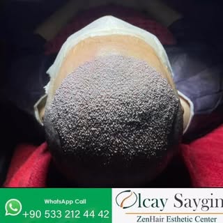 Zen Hair – Safe, Professional, and Personalized Hair Transplant Care
At Zen Hair, our priority is to