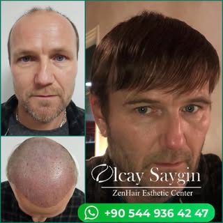 Zen Hair –  Excellence in Modern Hair Restoration

At Zen Hair, we combine medical expertise with ad