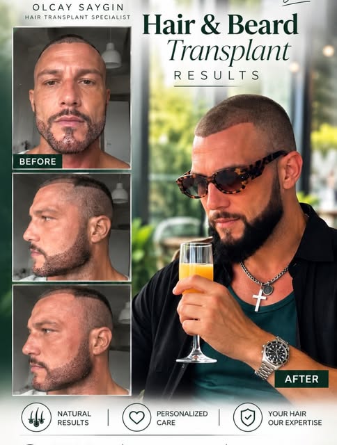 Hair & Beard Transplant – A New Look, A New Confidence ✨

Tired of looking in the mirror and feeling