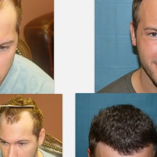 Hair transplant surgery can be a real life changer. Whether it’s a force for good or a drain on your