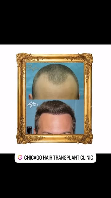 Hairline restoration is complex and requires great attention to detail and an artistic eye. Dr. Pani