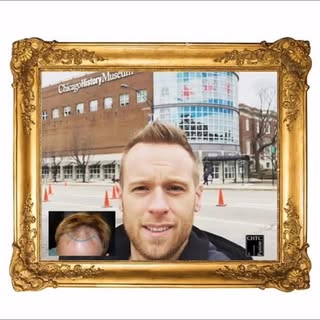This happens to be one of my favorite patients. His hairline restoration surgery results are epic. W