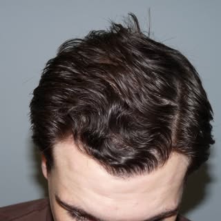 Real Patients with Real Results by 
@drpanine -
 
This is one of my favorite patients. He is a great