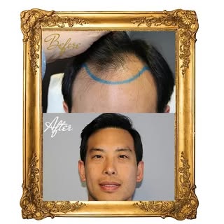 Real Patients with Real Results. 

This patient's result happens to be one of my favorite. His hairl