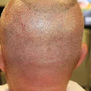 Just hours after surgery….
These photos show our patient’s donor area immediately following his FUE 