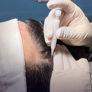 Greffe capillaire sans rasage, grâce au stylet Choi.

Une technique précise qui permet une implantat