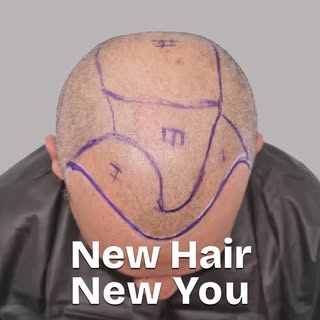 Every New Hair Is a Continuation of Your Story

Hair transplantation is not just about appearance — 