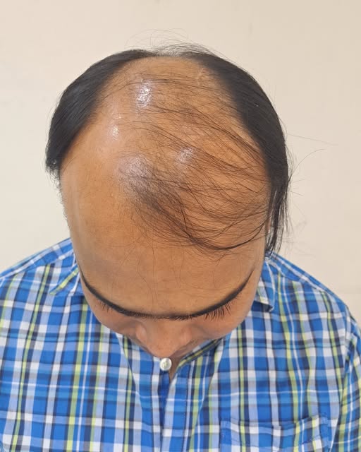🧑‍🦲 টাক মাথা কি আবার চুলে ভরে যেতে পারে?
👉 হ্যাঁ, অনেক ক্ষেত্রেই সম্ভব! তবে সঠিক কারণ, বয়স, টাকের