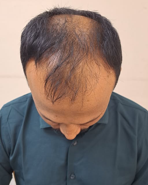 🔥 কুয়েত প্রবাসী ভাইয়ের ৫০০০ গ্রাফট হেয়ার ট্রান্সপ্লান্ট—নতুন চুলের পথে আরও এক ধাপ! 🇰🇼➡️🇧🇩

প্রব