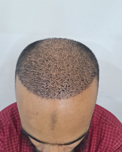 🧑‍🦲 Hair Transplant-এর ১০ দিন পর মাথায় কী হয়?—এটা কি স্বাভাবিক?

হেয়ার ট্রান্সপ্লান্ট করার পর ১০ দ