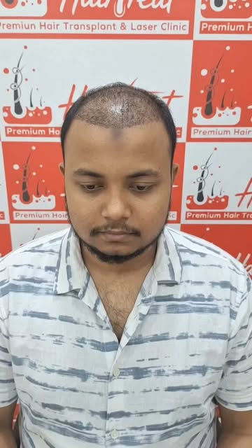 🔥 হেয়ার ট্রান্সপ্লান্টের ৬ মাস পর—কতটা পরিবর্তন আসে?

হেয়ার ট্রান্সপ্লান্টের পর ৬ মাসে অনেক রোগীর ম