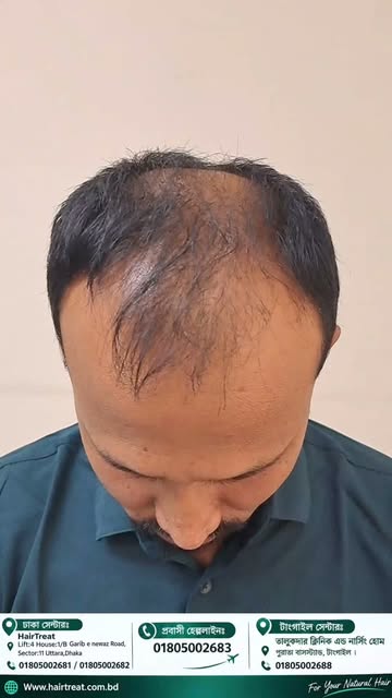 “বিদেশে থেকেও কেন Hair Transplant-এর জন্য বাংলাদেশকে বেছে নিলেন?” ✈️🇧🇩

কুয়েত প্রবাসী মাসুদ রানা ভ
