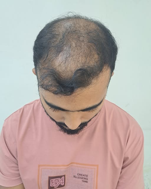 🔥 বাগেরহাট থেকে ঢাকায়, নতুন চুলের স্বপ্ন পূরণের যাত্রা! ❤️

আলহামদুলিল্লাহ! 🤲

বাগেরহাট থেকে আমাদে