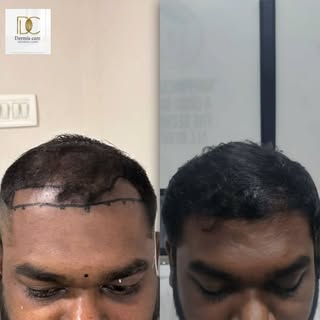 Advanced FUE techniques with minimal graft damage are performed here.

To know more take free consul