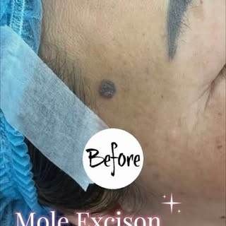 Surgical removal of mole.