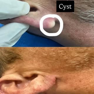Cyst Excision.