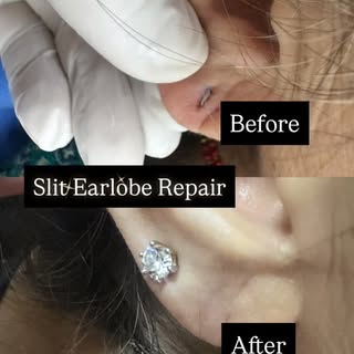 Slit Earlobe Repair 🤍