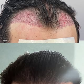 This was only 1744 grafts placed strategically to reconstruct frontotemporal loss. This is just 6 mo