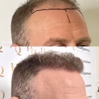 This was only 2784 grafts placed strategically to reconstruct frontotemporal loss. This is just 6 mo