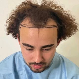 This was just shy of 2,900 grafts placed strategically to reconstruct frontotemporal loss. This is a