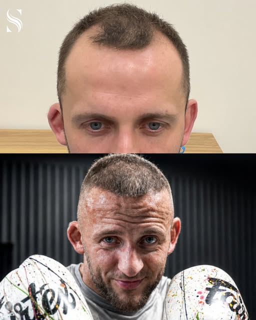 2,081 grafts placed. One surgeon, one patient, start to finish. This is only 6 months post-op. 

Res