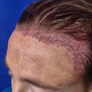 Female hairline restoration isn't about chasing a trend — it's about restoring what's naturally your