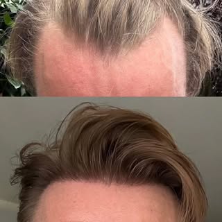 Frontal hairline restoration — 1,273 grafts.

This patient came to us with a receded hairline and wa